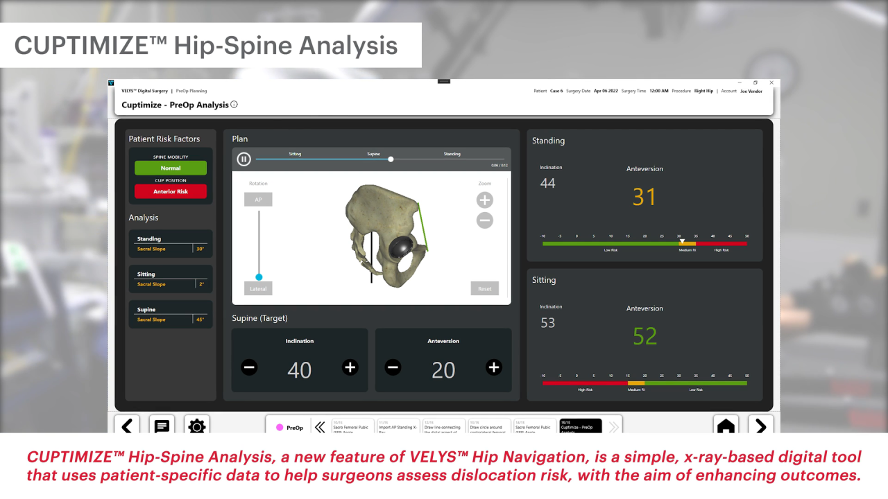 Image from CUPTIMIZE™ Advanced Hip-Spine Analysis & Guidance: Accuracy & Efficiency