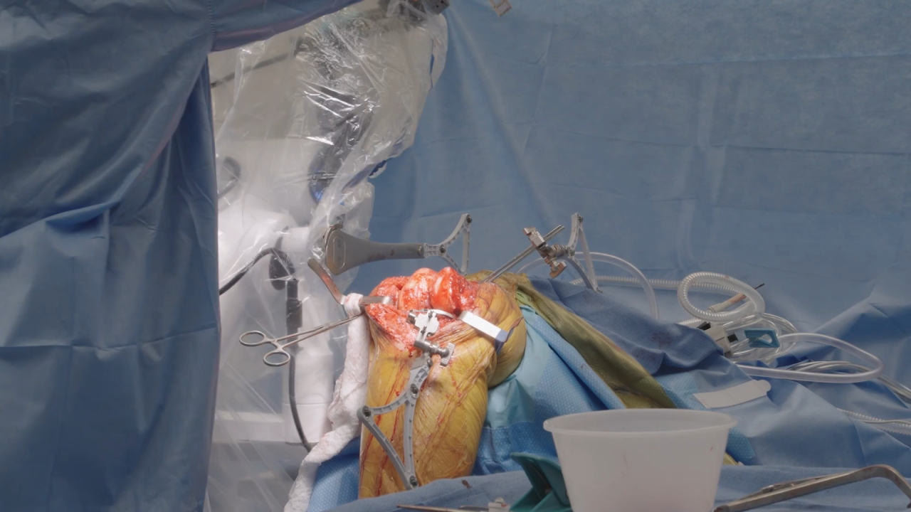 Image from Technology and Efficiency in the ASC Setting: Tibial First Workflow and Personalized Alignment with VELYS Robotic-Assisted Solution - Timothy B. Alton, MD
