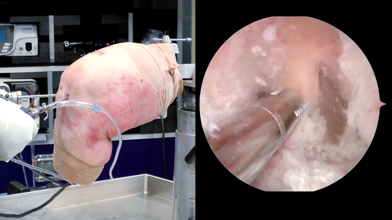 Image from Posterior Cruciate Ligament Reconstruction - Michael Alaia, MD