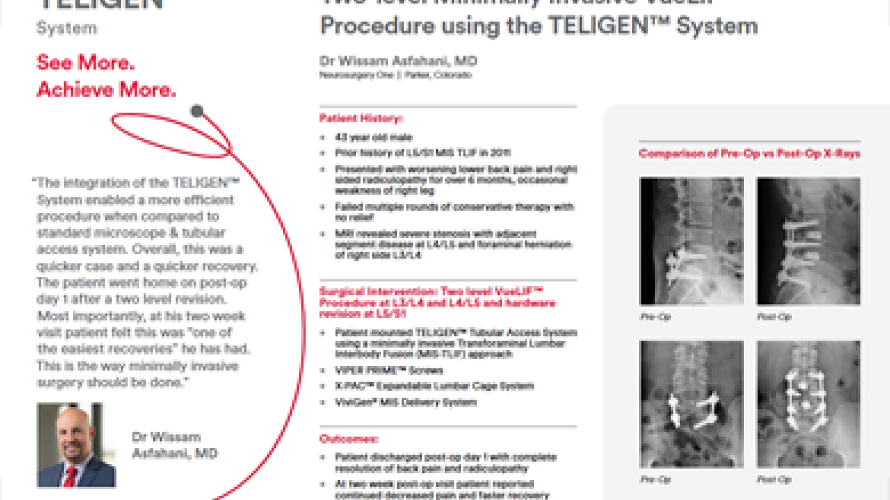 An Image From "Two-level Minimally Invasive VueLIF™ Procedure using the TELIGEN™ System - Wissam Asfahani, MD"