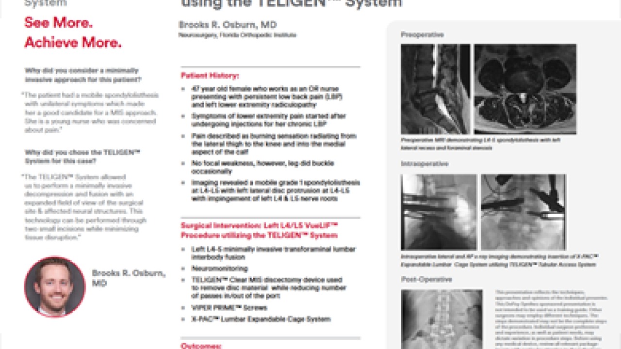 An Image From "Minimally Invasive VueLIF Procedure using the TELIGEN™ System - Brooks Osburn, MD"