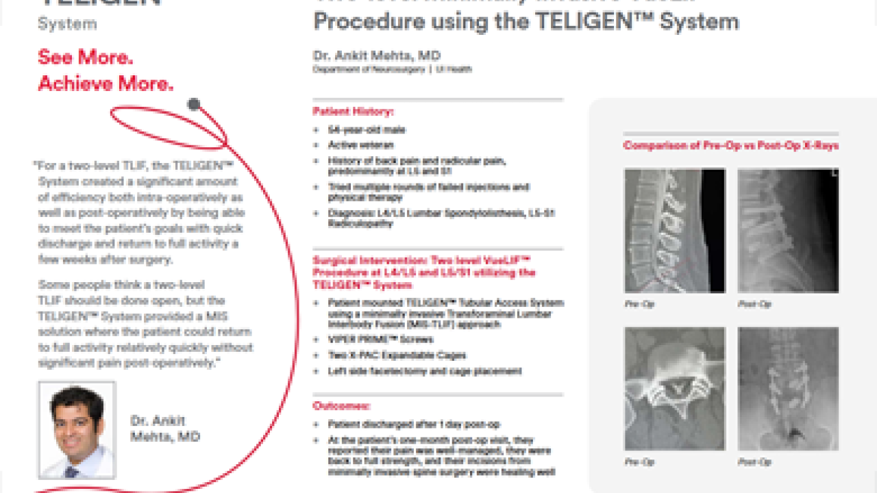 An Image From "Two-level Minimally Invasive VueLIF Procedure using the TELIGEN™ System - Ankit Mehta, MD"