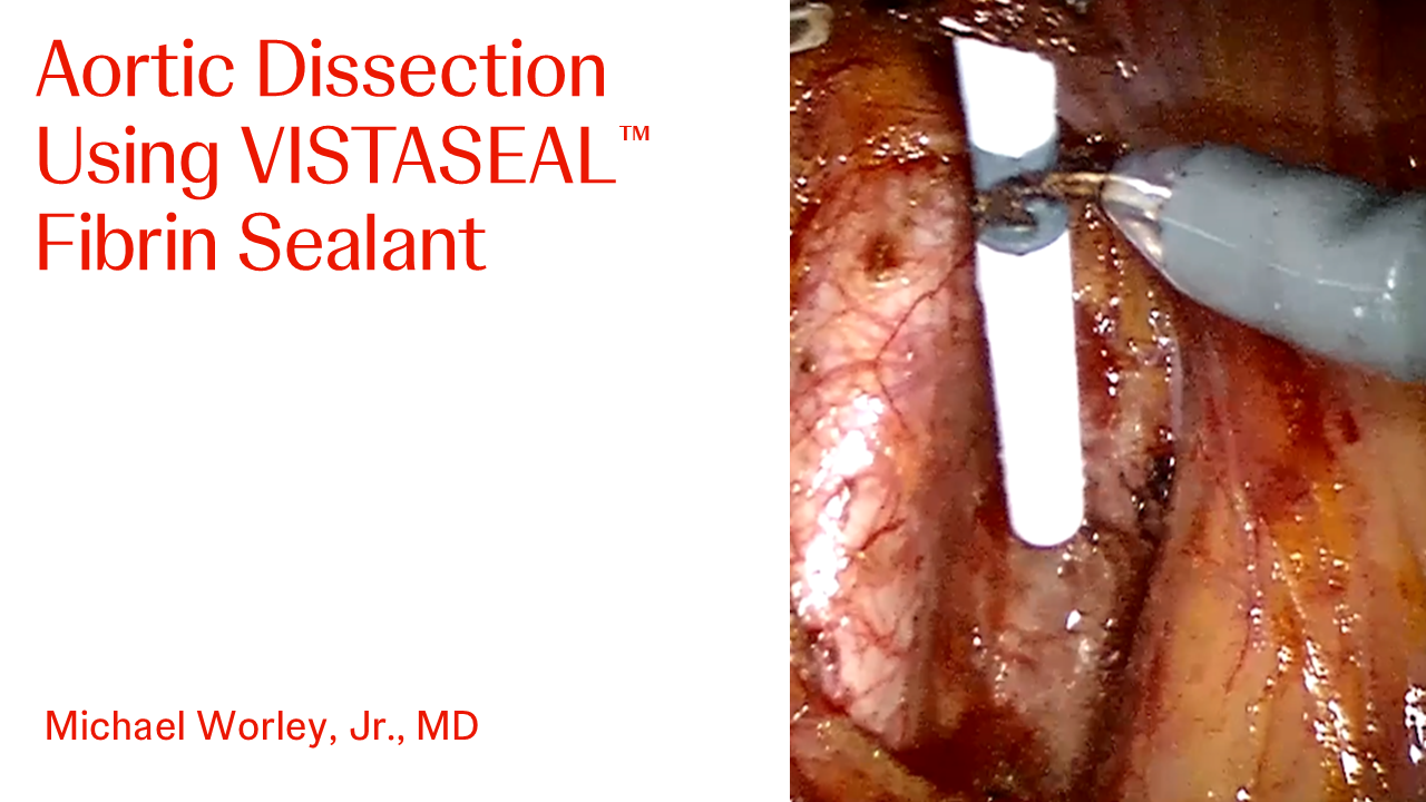 An Image From "Aortic Dissection Using VISTASEAL™ Fibrin Sealant with Michael Worley, Jr., MD"
