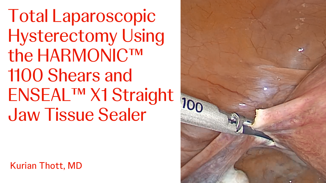 An Image From "Total Laparoscopic Hysterectomy Using HARMONIC™ 1100 Shears and ENSEAL™ X1 Straight Jaw Tissue Sealer with Kurian Thott, MD"