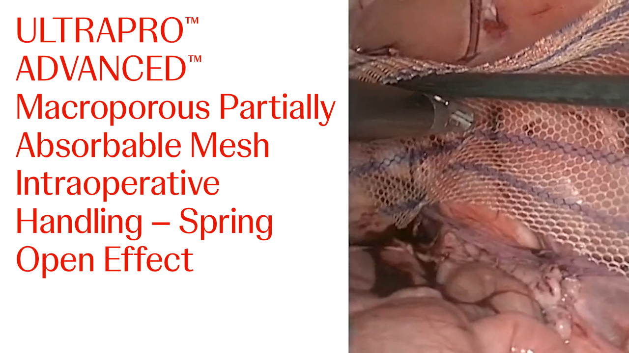 An Image From "ULTRAPRO ADVANCED™ Macroporous Partially Absorbable Mesh Intra-Operative Handling"