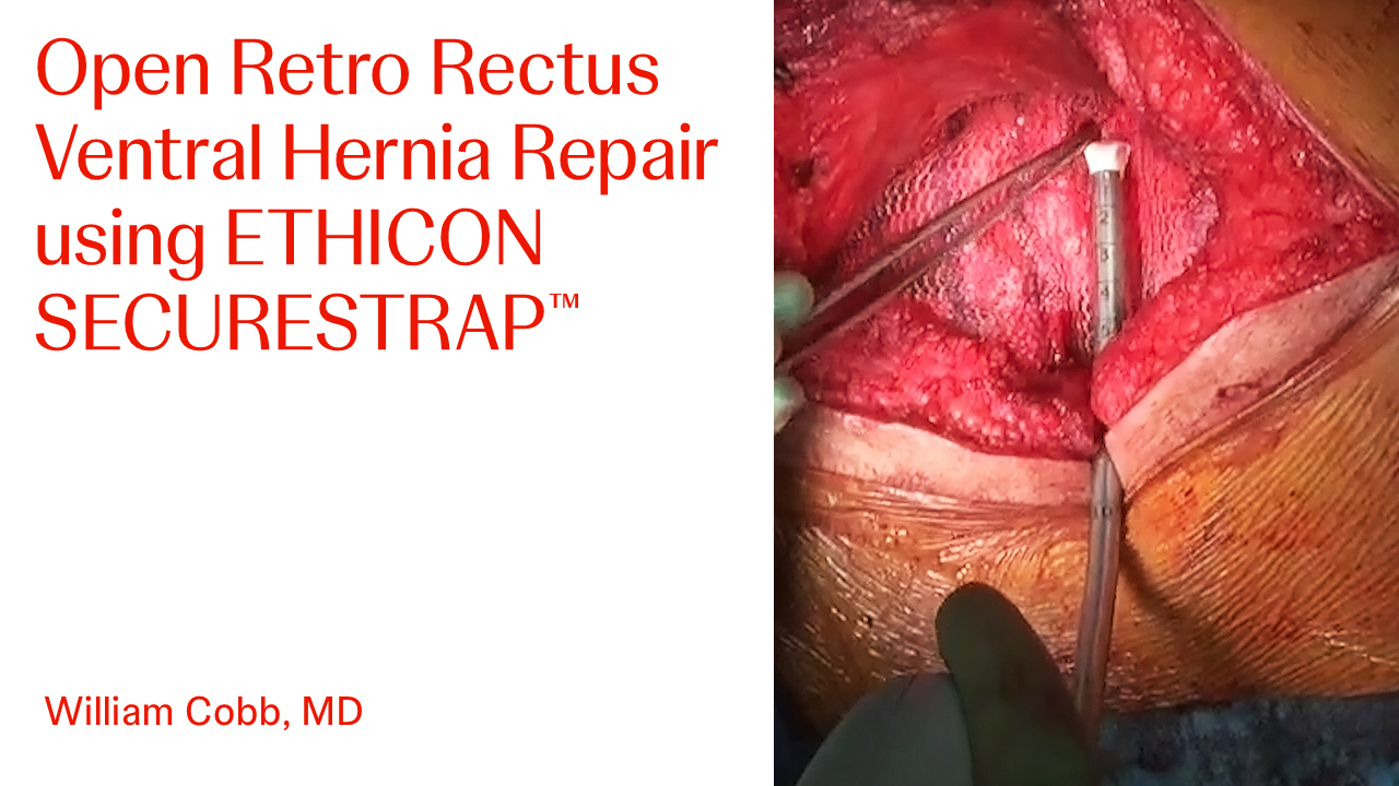 An Image From "Open Retro Rectus Ventral Hernia Repair using ETHICON SECURESTRAP™ with William Cobb, MD"