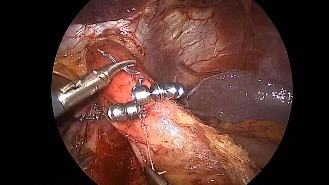 LINX Reflux Management System Procedure (Abbreviated) with John Lipham, MD