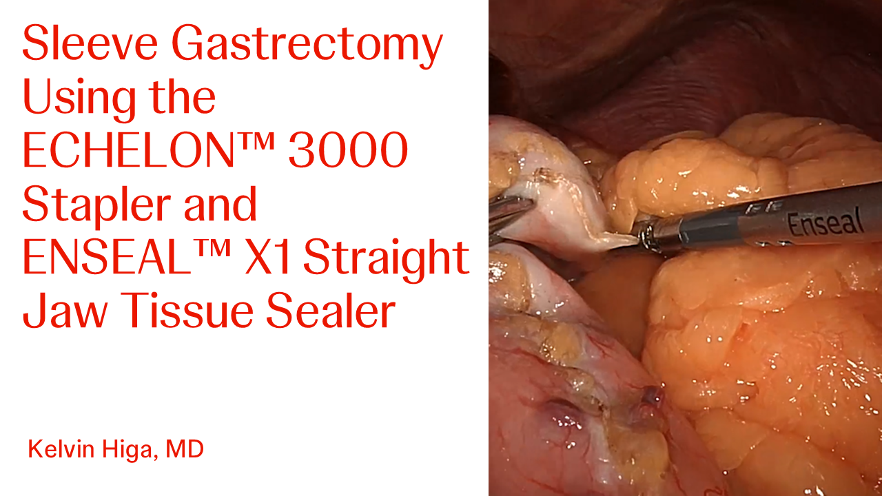 An Image From "Sleeve Gastrectomy using the ECHELON 3000 Stapler with Kelvin Higa, MD"