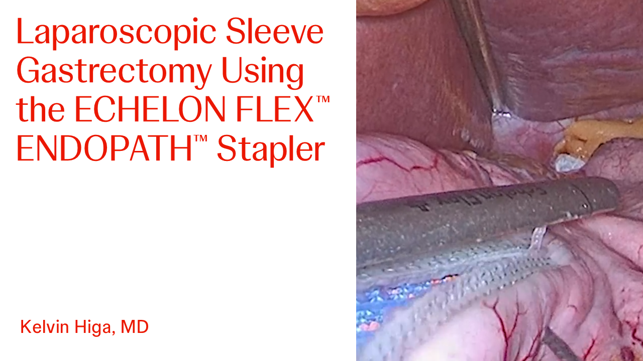 An Image From "Laparoscopic Sleeve Gastrectomy Using the ECHELON FLEX™ ENDOPATH™ Stapler with Kelvin Higa, MD"