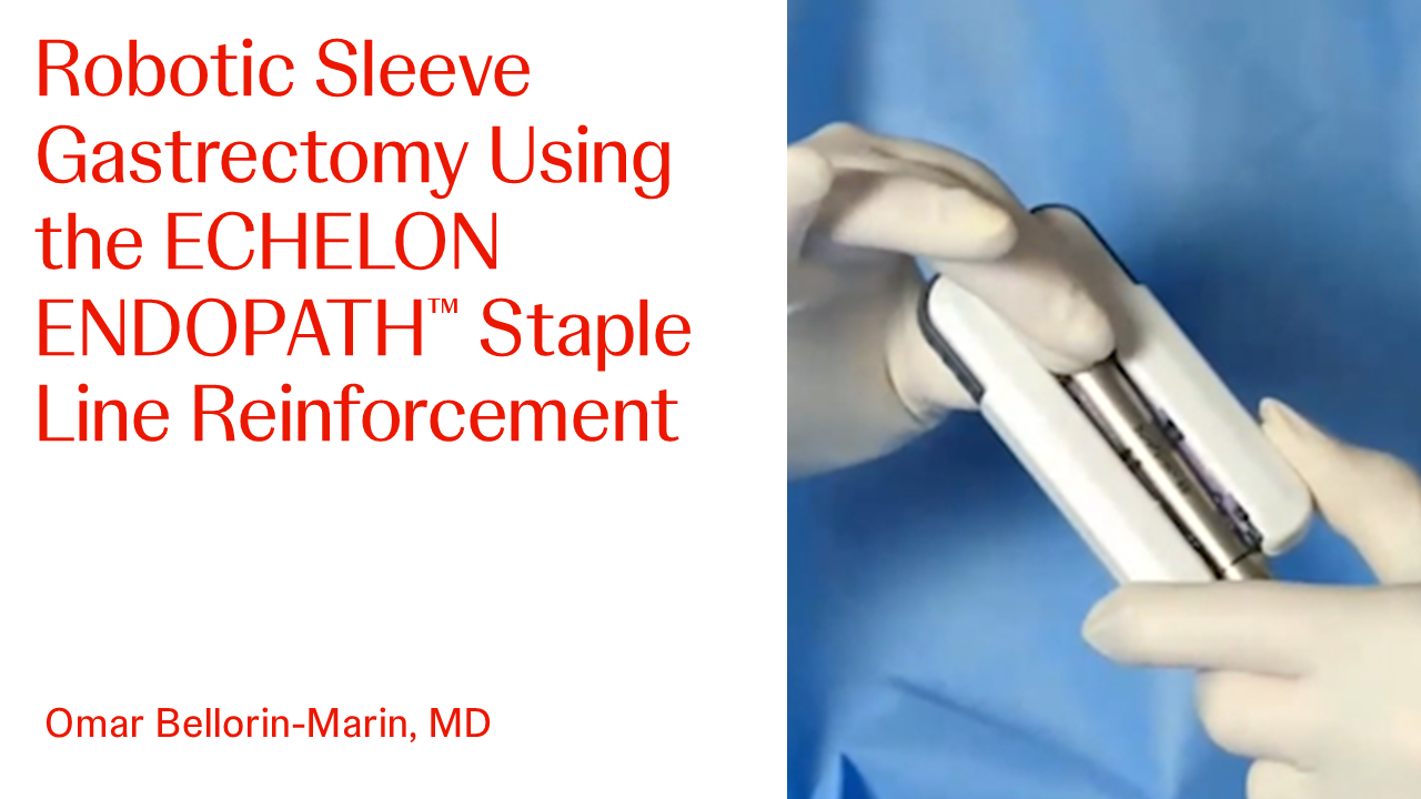 An Image From "Robotic Sleeve Gastrectomy Using the ECHELON ENDOPATH™ Staple Line Reinforcement with Omar Bellorin-Marin, MD"