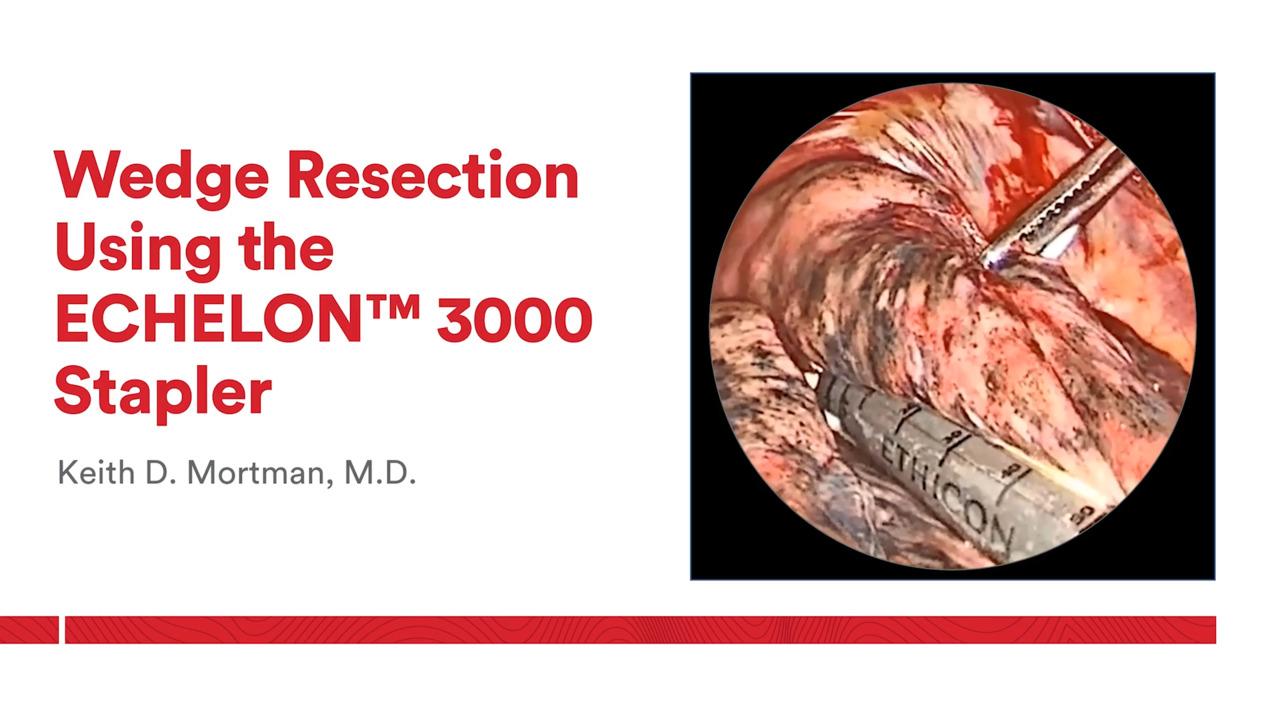 An Image From "Wedge Resection Using the ECHELON™ 3000 Stapler with Keith Mortman, MD"