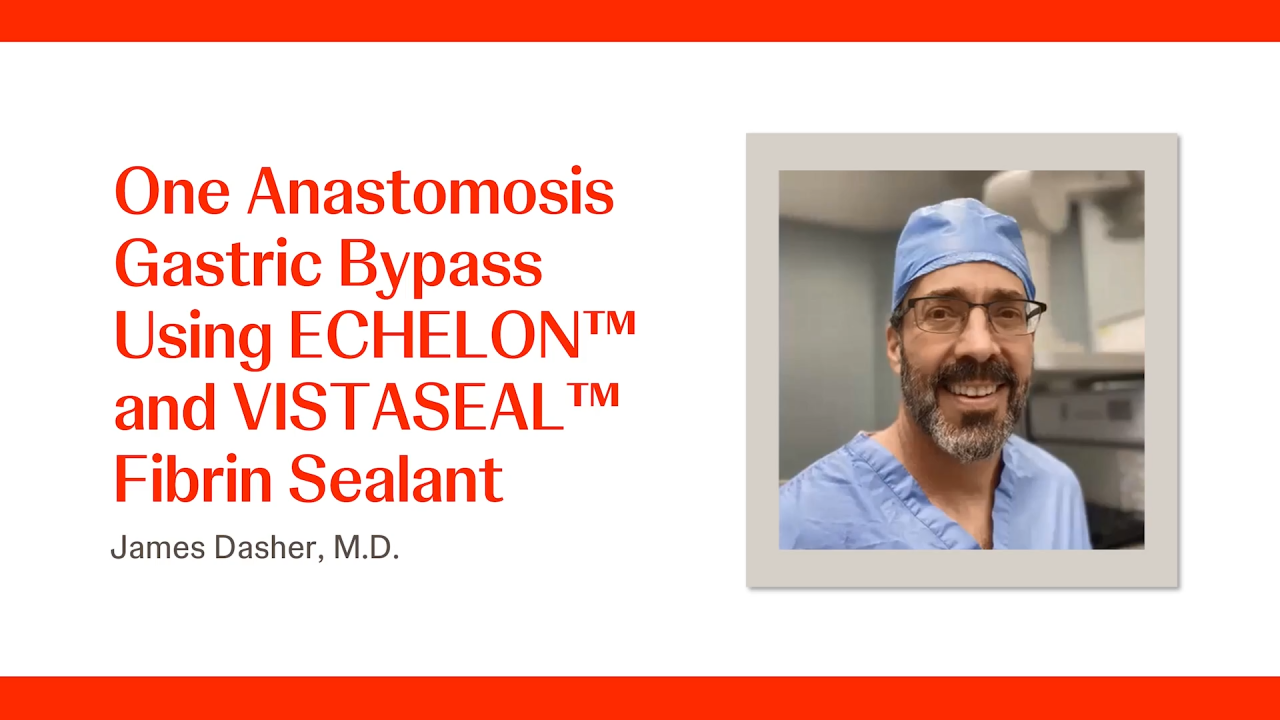 An Image From "One Anastomosis Gastric Bypass Using ECHELON™ and VISTASEAL™ Fibrin Sealant with James Dasher, MD"