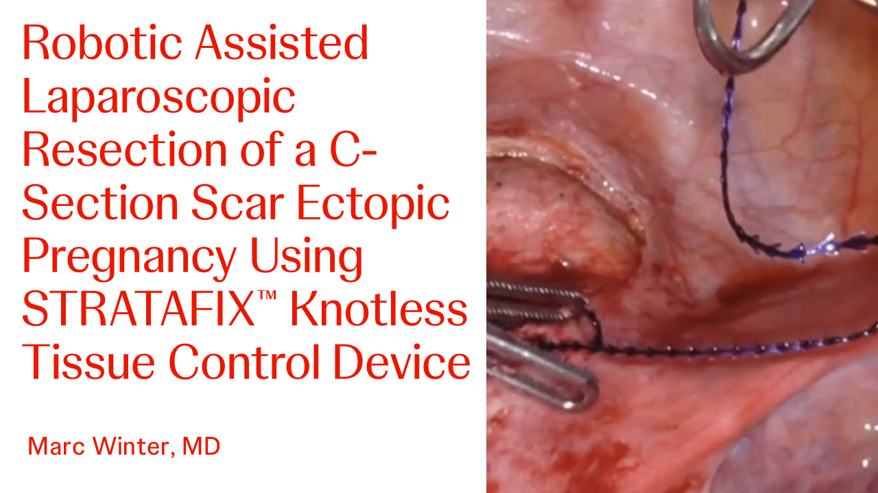 An Image of "Robotic Assisted Laparoscopic Resection of a C-Section Scar Ectopic Pregnancy Using STRATAFIX™ Knotless Tissue Control Device with Marc Winter, MD"