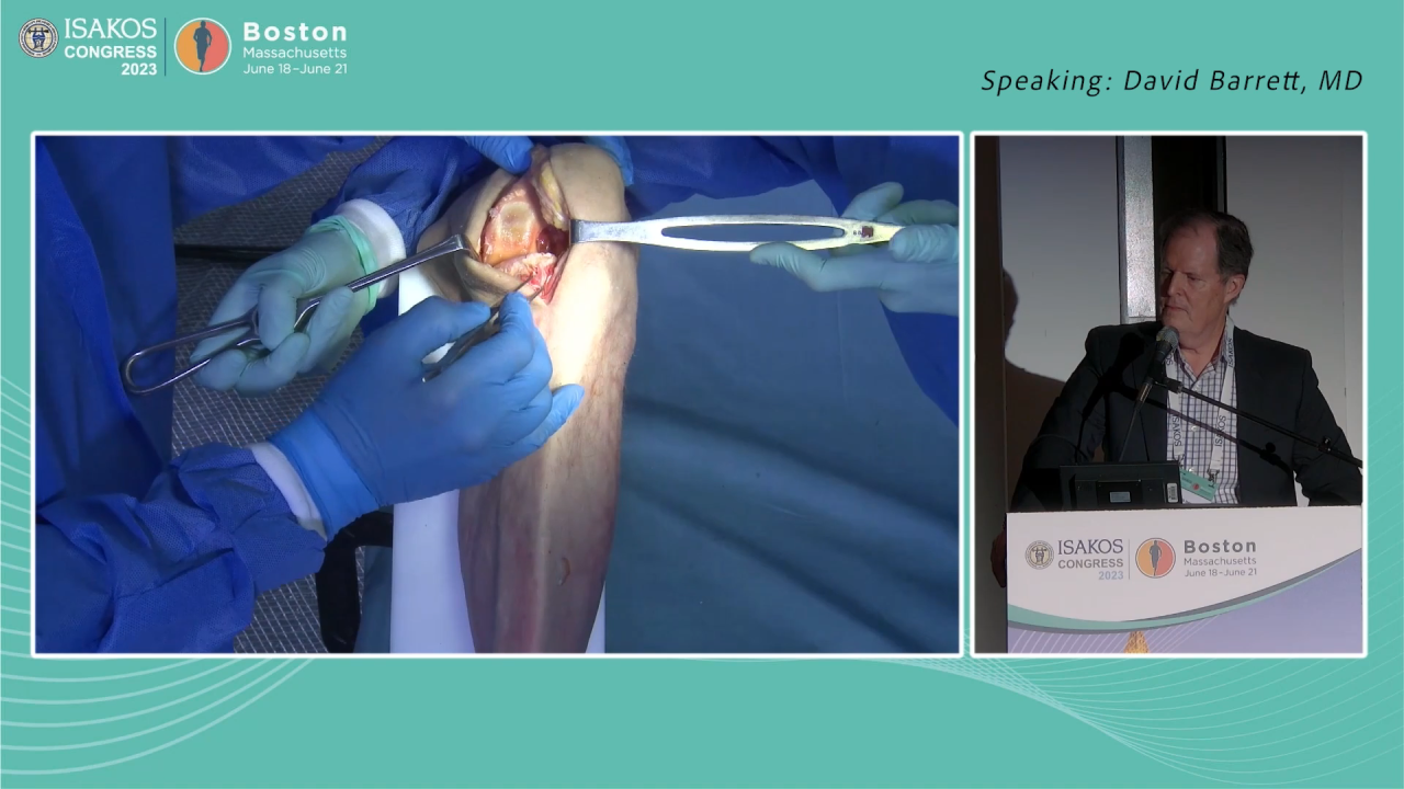 Unicompartmental Knee Procedural Workflow - David Barrett, MD & David Dalury, MD thumbnail image