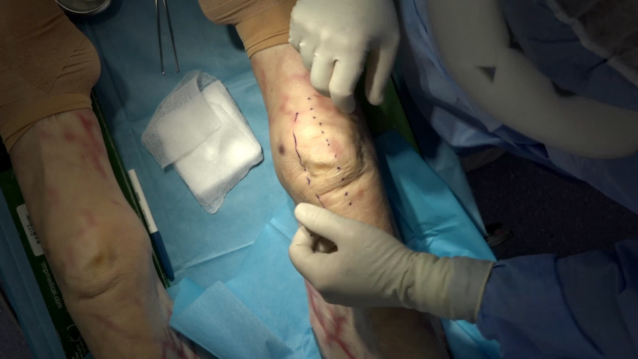 Unicompartmental Knee Procedural Workflow with INTUITION Instruments - David Dalury, MD thumbnail