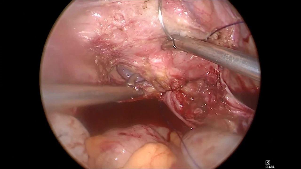 An Image From "Needle Backloading Cuff Closure - Dr. Thott"