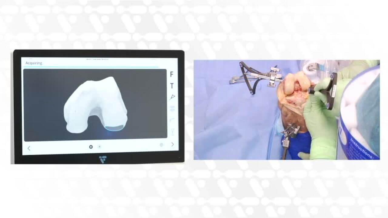 A header image of VELYSTM Robotic-Assisted Solution Total Knee Arthroplasty Procedure: Tibia First Approach