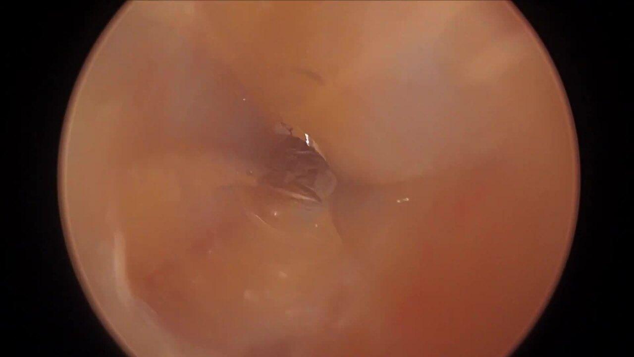 Laparoscopic Right Hemicolectomy - Initial Access
