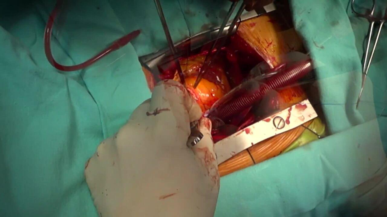 Aortic Valve Replacement (AVR) - Accessing The Aortic Valve 1/3