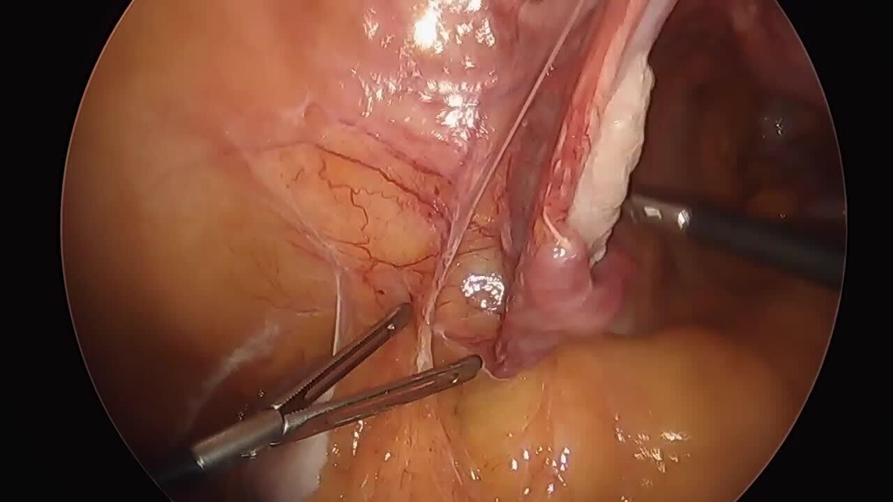 Total Laparoscopic Hysterectomy - Adhesiolysis