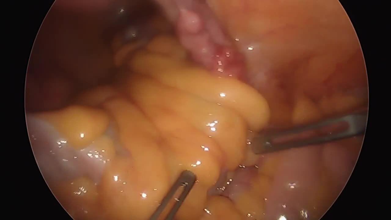 Total Laparoscopic Hysterectomy - Anatomic Survey