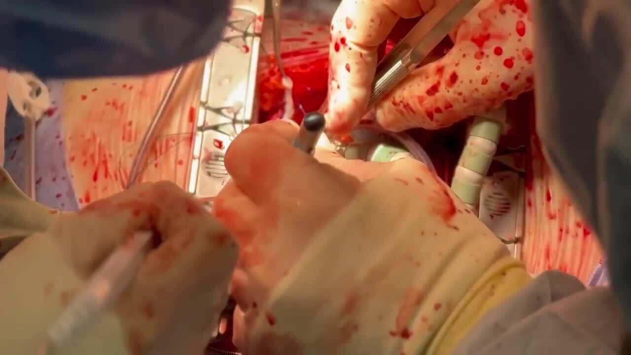 Coronary Artery Bypass Grafting (CABG) - Suturing the Anastomosis 1/2