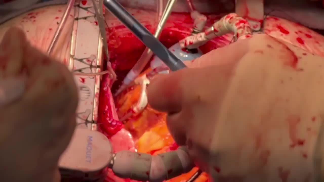 Coronary Artery Bypass Grafting (CABG) - Suturing the Anastomosis 2/2
