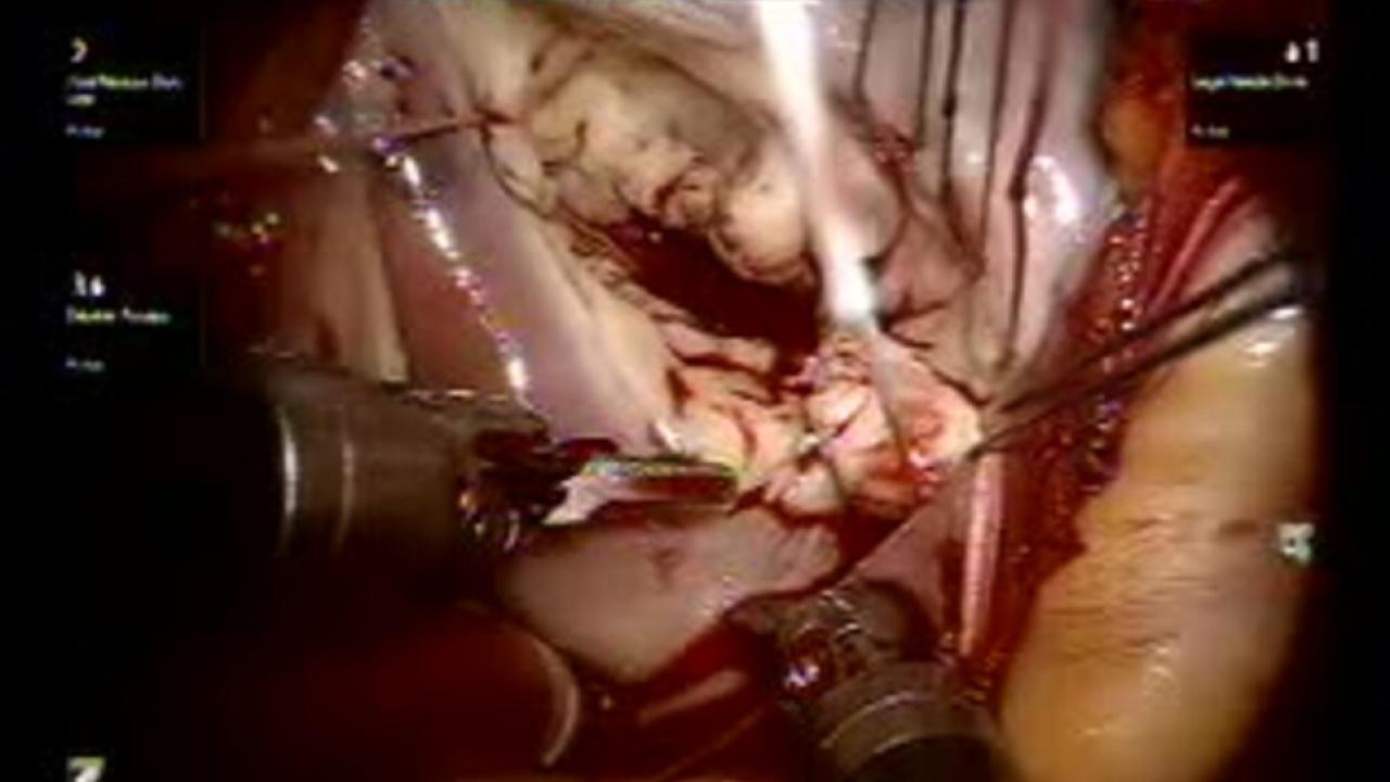 Mitral Valve Repair (MVR) - Annuloplasty 1/3