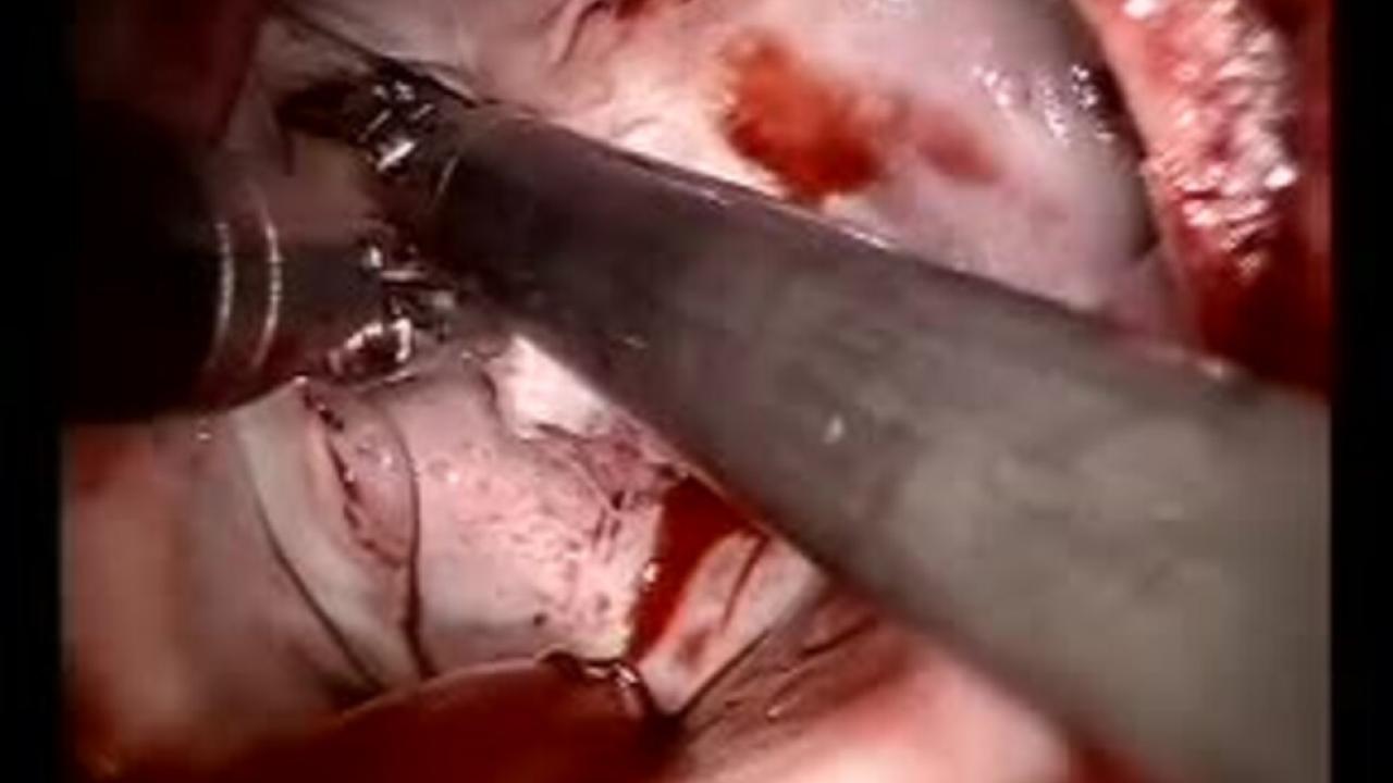 Mitral Valve Repair (MVR) - Inspection of Anterior Perforation