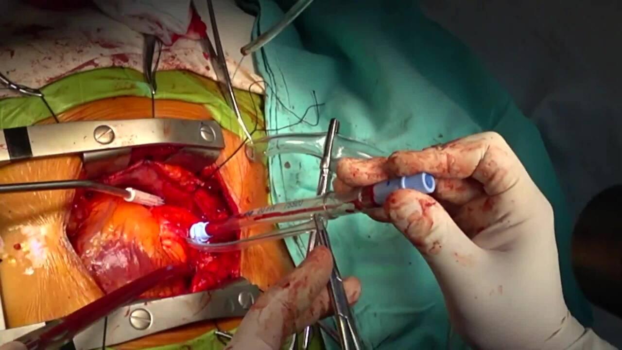 Aortic Valve Replacement (AVR) - Arterial Cannula Placement