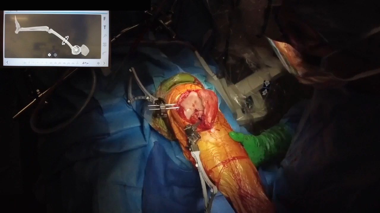VELYS Robotic-Assisted Solution: Landmark Acquisition by Dr. William Barrett thumbnail image