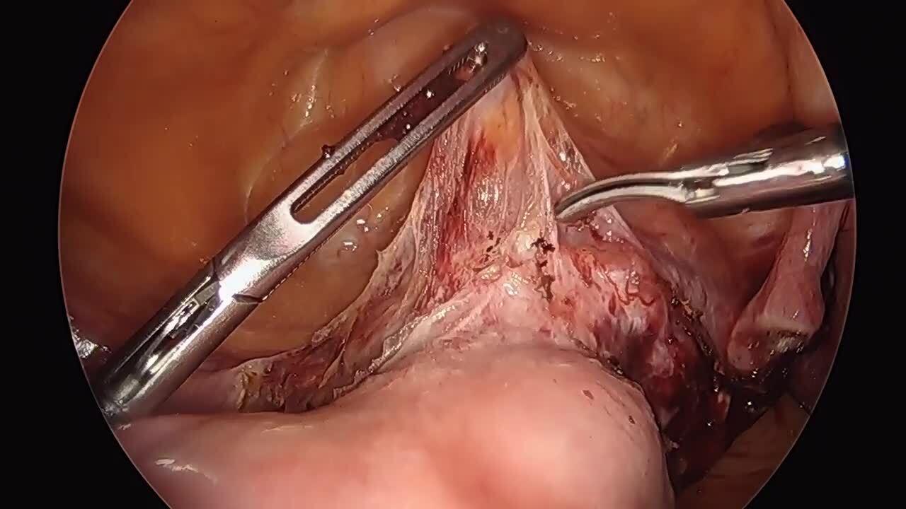 Total Laparoscopic Hysterectomy - Create Bladder Flap