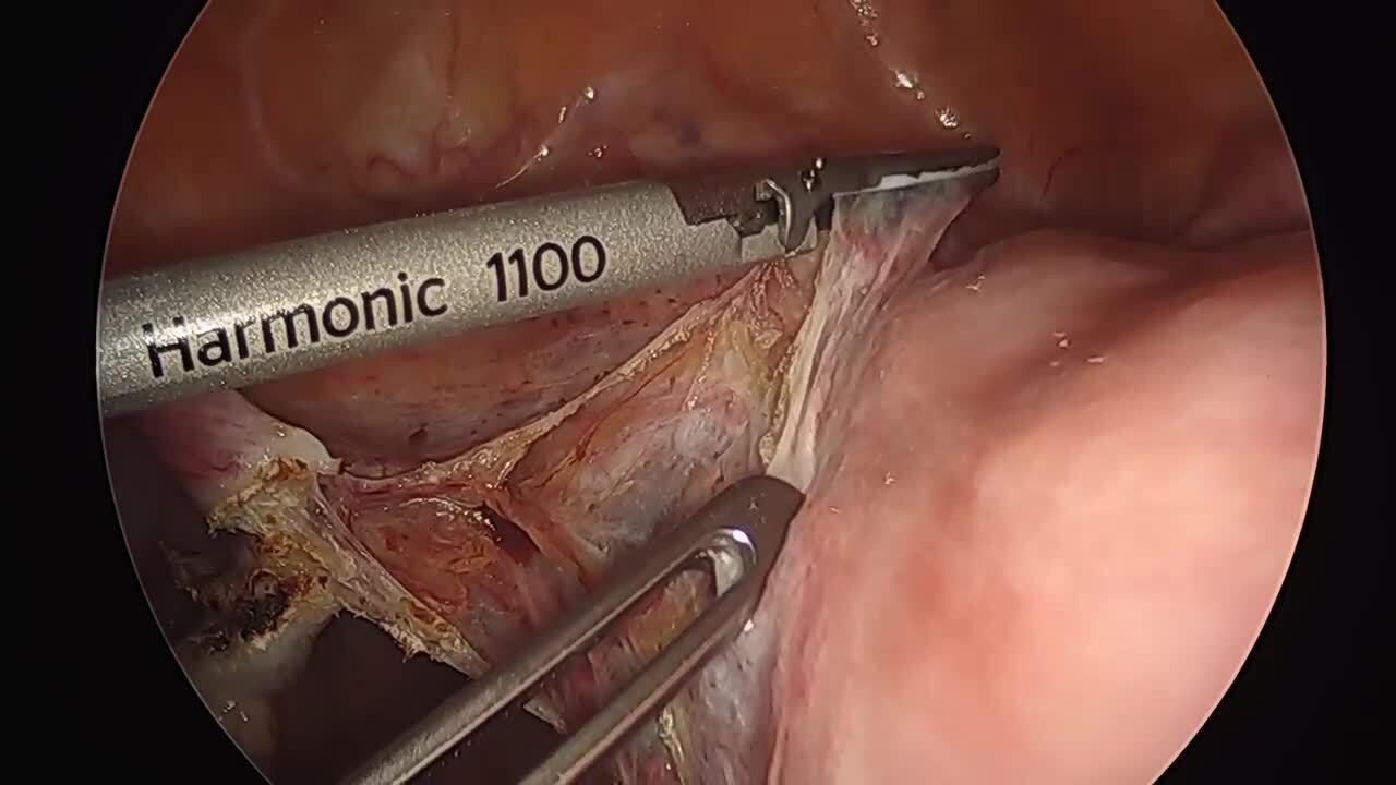 Total Laparoscopic Hysterectomy - Divide Broad Ligament