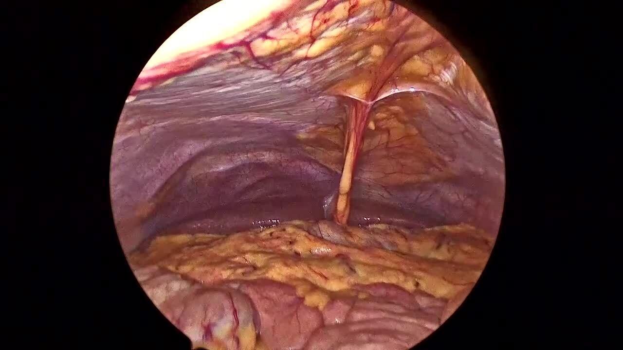 Laparoscopic Appendectomy - Closure