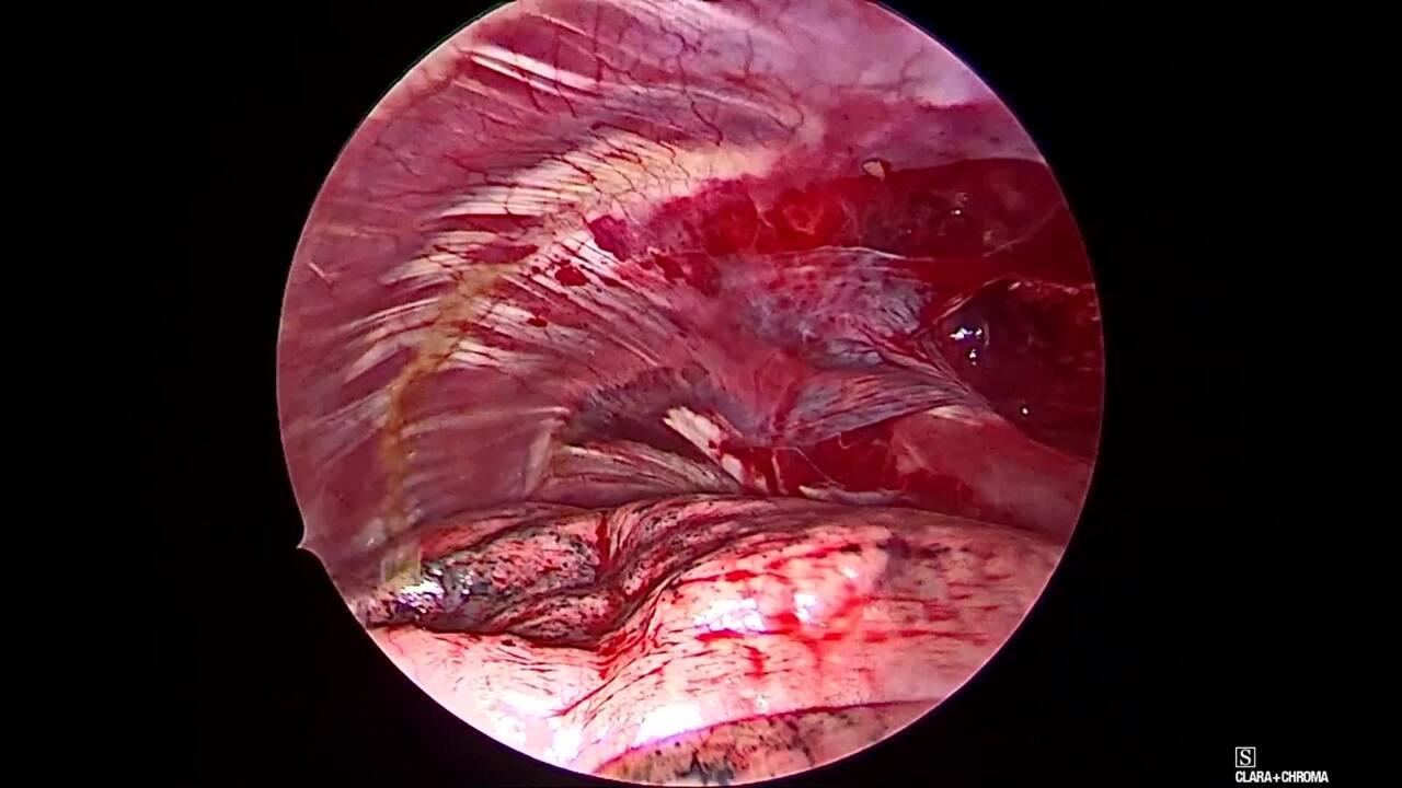 Thorascopic Lobectomy - Chest Tube Placement