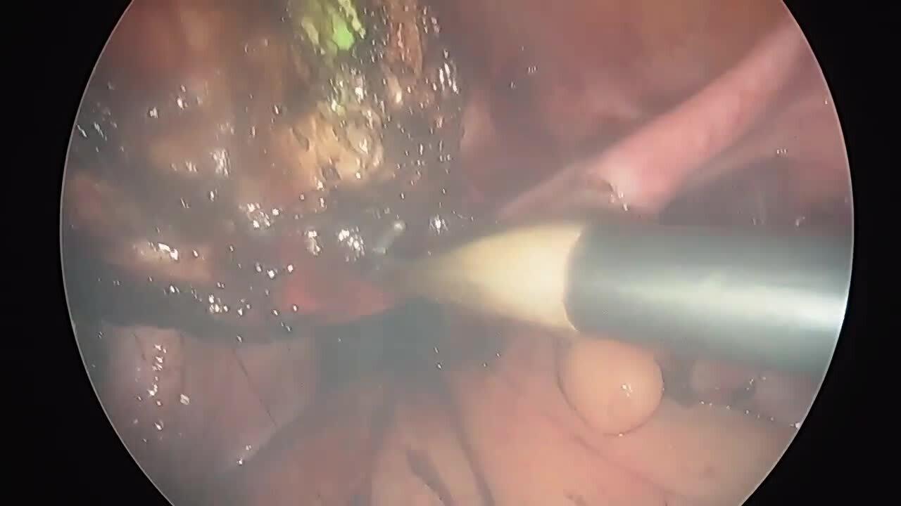 Total Laparoscopic Hysterectomy - Perform Colpotomy