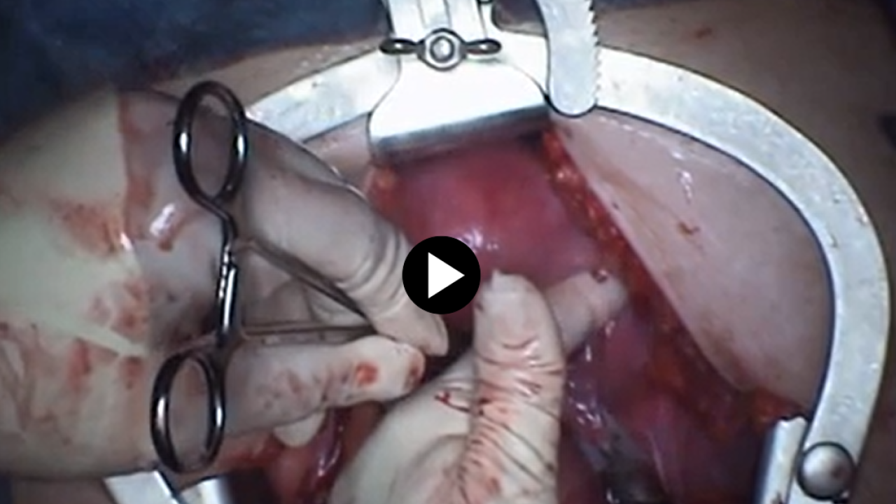 Total Abdominal Hysterectomy - Divide IP Ligament