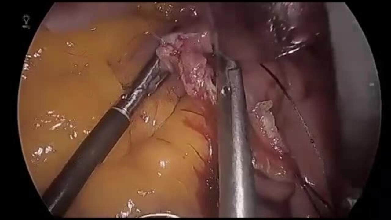 Laparoscopic Roux-en-Y Gastric Bypass - Enterotomy Closure
