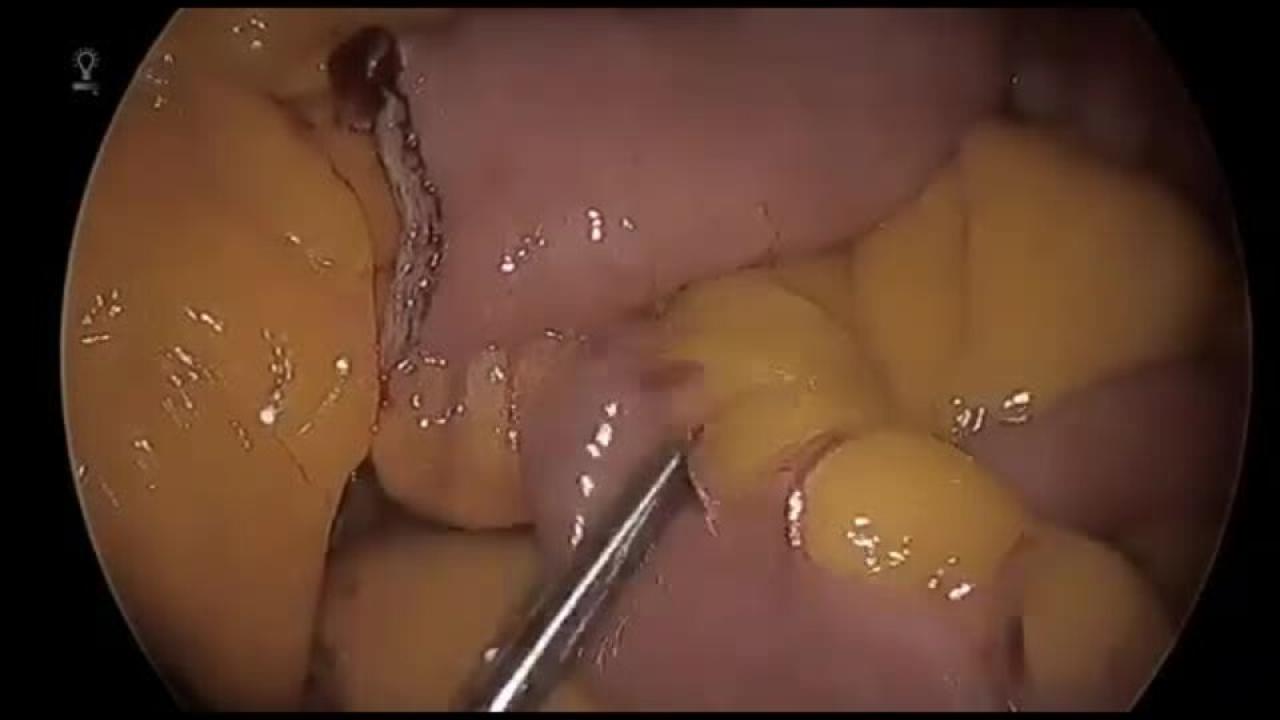 Laparoscopic Roux-en-Y Gastric Bypass - Create Enterotomies