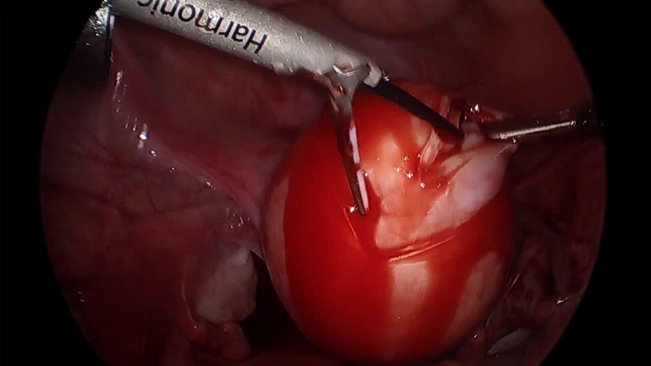 Laparoscopic Myomectomy - Expose Fibroid