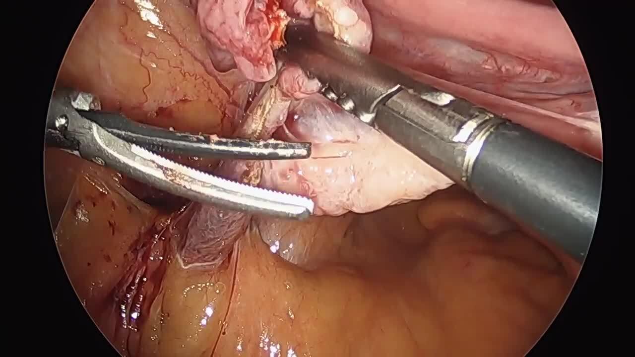 Total Laparoscopic Hysterectomy - Ligate & Divide Mesosalpinx