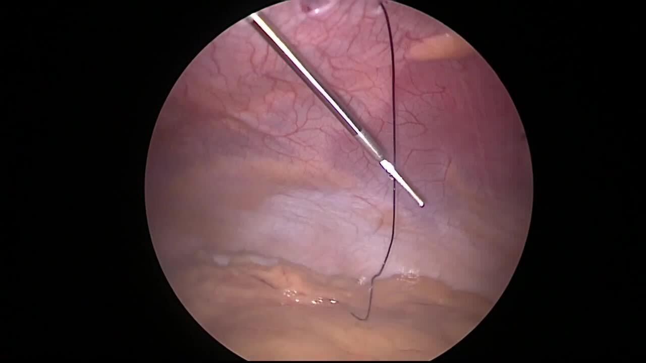 Laparoscopic Cholecystectomy - Close Fascia