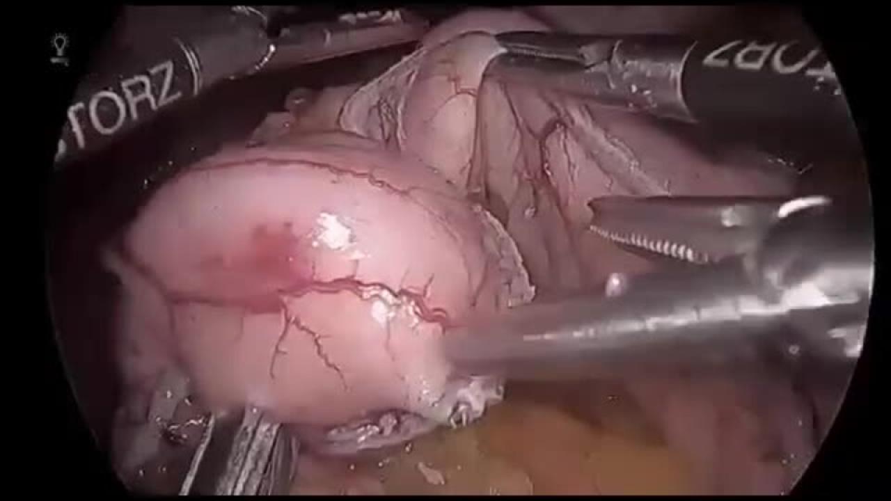 Laparoscopic Roux-en-Y Gastric Bypass - Creation of Gastrojejunostomy