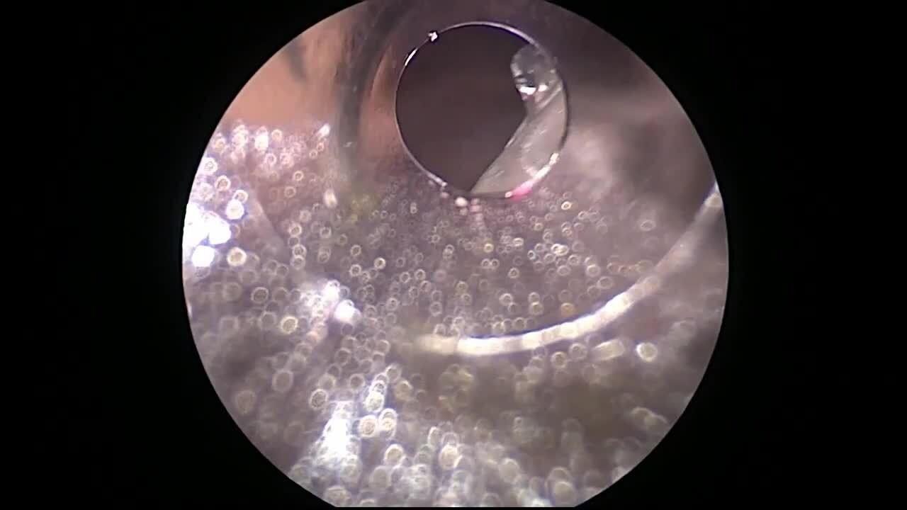 Laparoscopic Cholecystectomy - Removal of Gallbladder