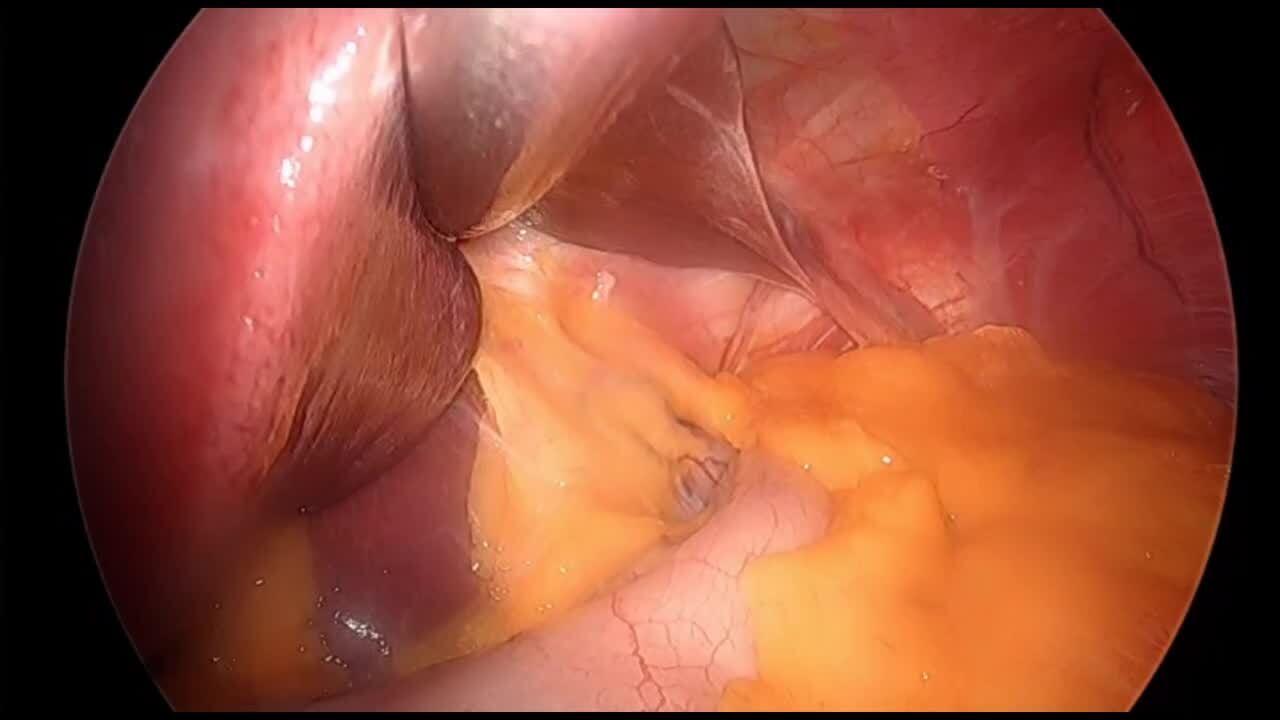 Laparoscopic Sleeve Gastrectomy - Identify the Pylorus & Begin Dissection
