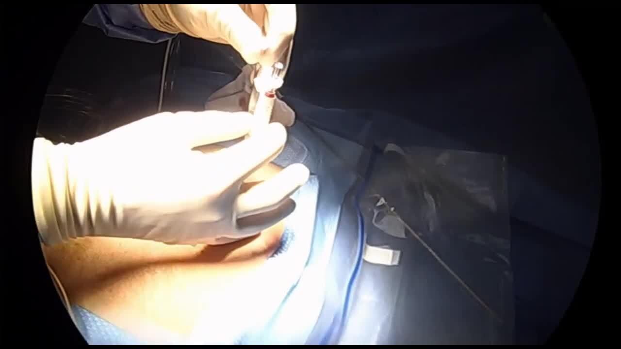 Laparoscopic Sleeve Gastrectomy - Initial Access