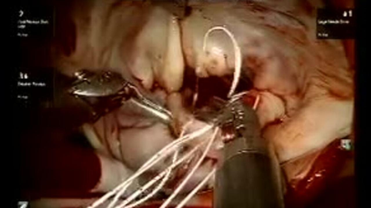 Mitral Valve Repair (MVR) - Insertion of Loops onto Leaflets 2