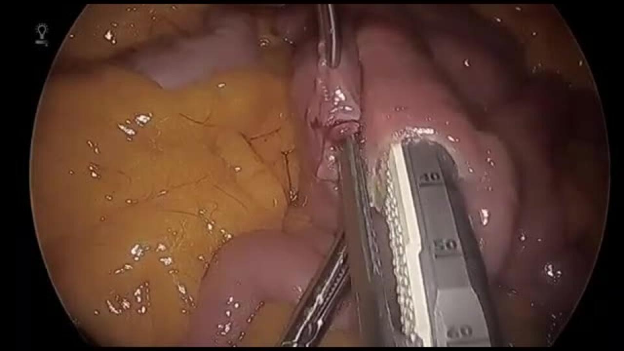 Laparoscopic Roux-en-Y Gastric Bypass - Create Jejunostomy