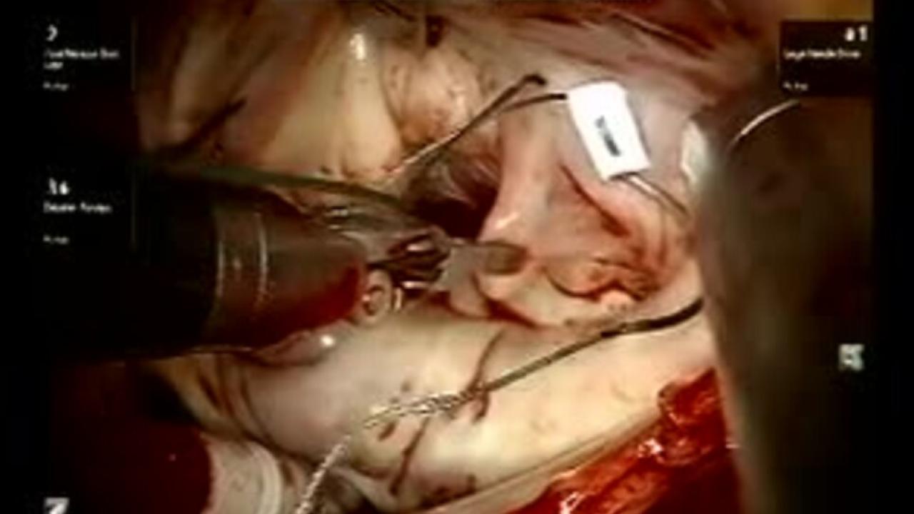 Mitral Valve Repair (MVR) - Knot Tying of Loops