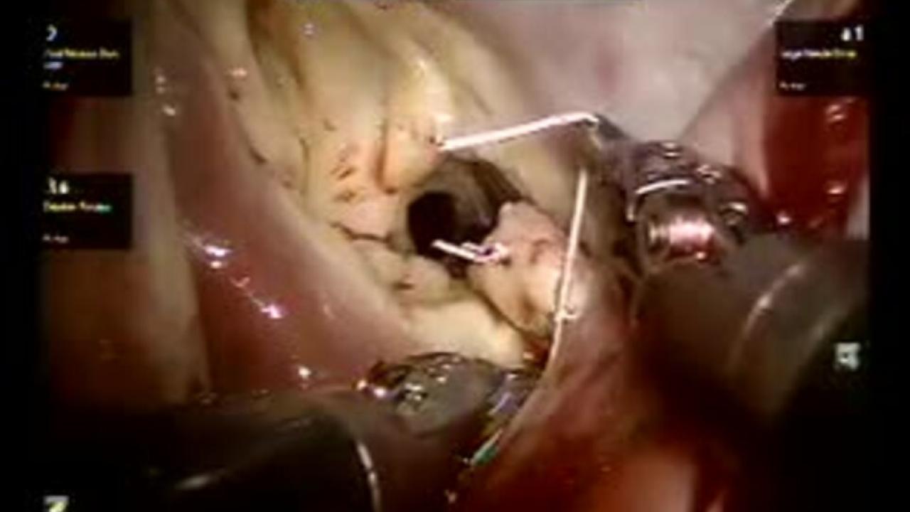Mitral Valve Repair (MVR) - Leaflet Resection & Suturing